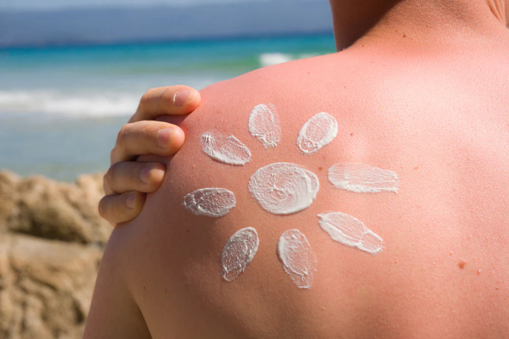 6 Tips for Treating a Sunburn This Summer